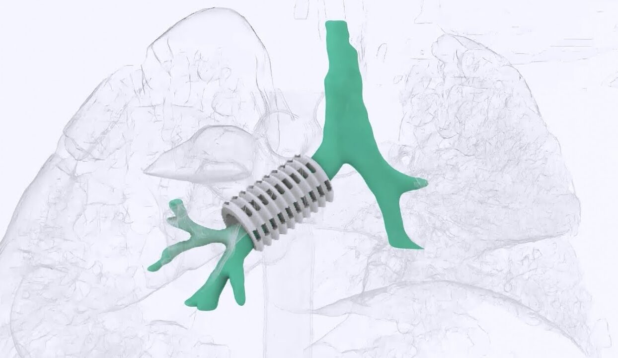Stent bronco sls 3d
