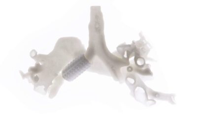 Prosilas and Bambino Gesù Hospital: 3D printed bronchial stent for a 5 year old patient