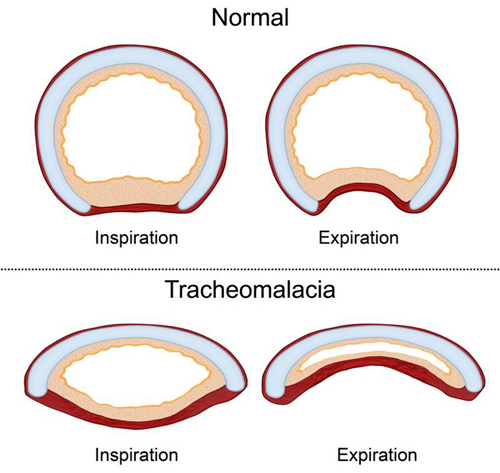 tracheomalacia stampa 3d