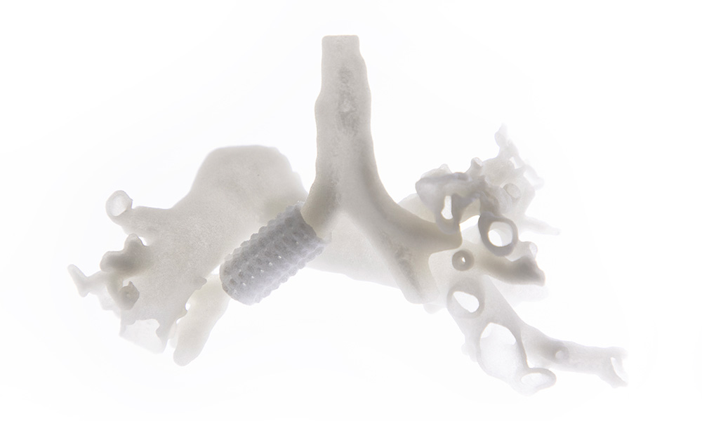 Bronco 3D Prosilas Prototal Stampa 3D Bambino Gesù Prosilas Stampa 3D Medicale